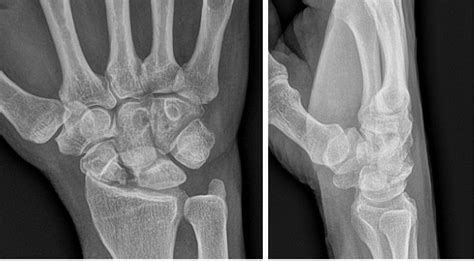 Radiographic Evaluation Of Vascularity In Scaphoid Nonunions A Review