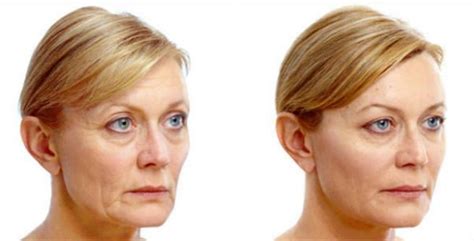 This Is A Before And After Of Juvederm Voluma It Is Injected To The