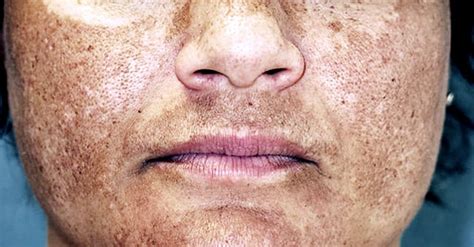 Uneven Skin Tone On The Face And Body Premier Clinic