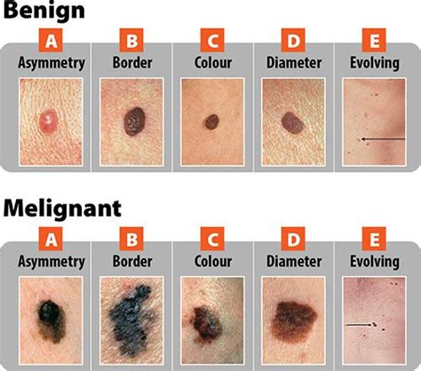 Do Abcdes Always Apply To Melanoma Can Cancer Look Normal Scary