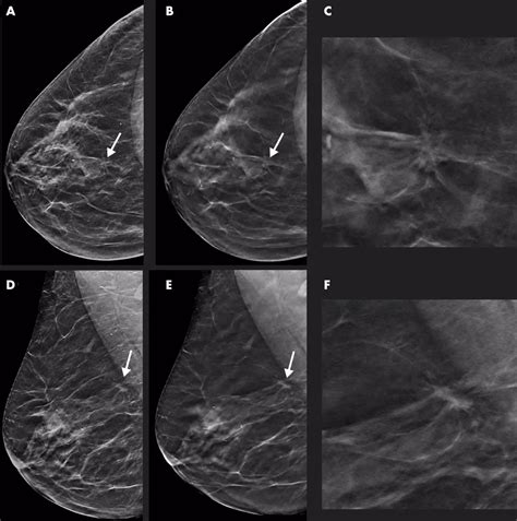 Dbt Helps In Early Detection Of Breast Cancer Compared To Mammography