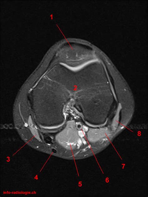 Overuse injuries of the knee include tendonitis, bursitis, muscle strains, and iliotibial band syndrome. Atlas of Knee MRI Anatomy - W-Radiology