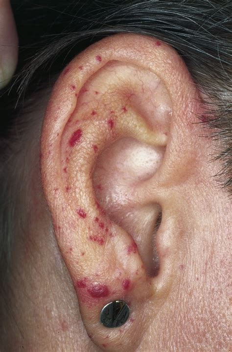 Cutaneous Lesions Of The External Ear Head And Face Medicine Full Text