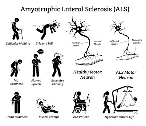 Amyotrophic Lateral Sclerosis Als Disease Signs Symptoms Etsy