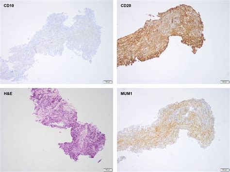 Diffuse Large B Cell Lymphoma Cutaneous Presentation Bmj Case Reports