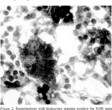 Figure 2 From Rosai Dorfman Disease In A Patient With Systemic Lupus