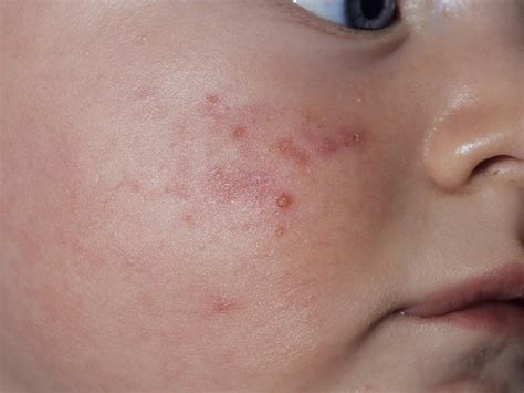 Skin rashes are among the most common skin conditions that occur on the baby's face as well as other parts of the body including the head, neck, chest, and legs. Visual guide to children's rashes and skin conditions ...