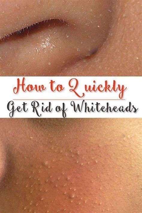 How To Get Rid Of Whiteheads Naturally With Images Whiteheads