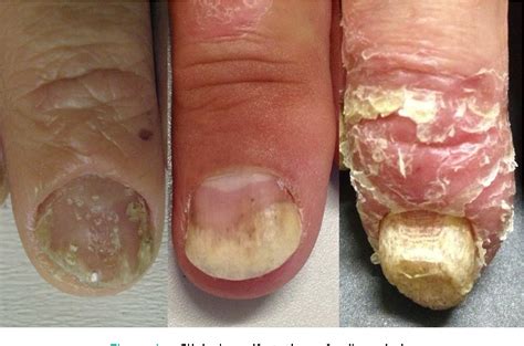 Figure 3 From Nail Psoriasis As A Predictor Of The Development Of