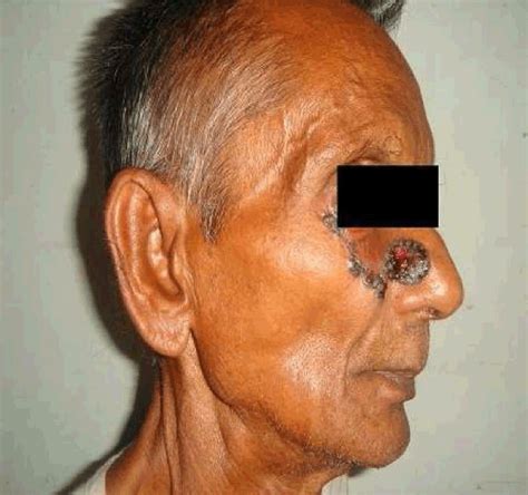 Full Text Cutaneous Basaloid Squamous Cell Carcinoma Of The Face A