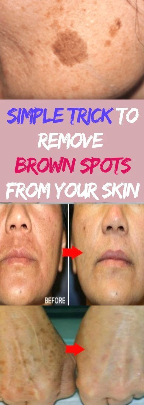 Simple Trick To Remove Brown Spots From Your Skin In 2020 Spots On