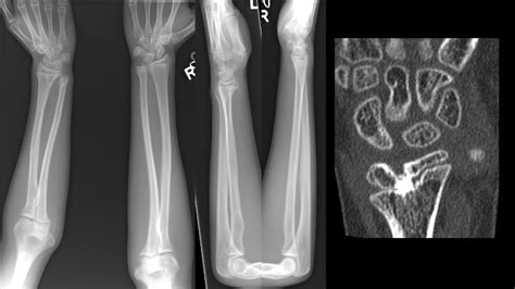 Pediatric Forearm Fractures Musculoskeletal Key