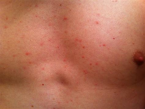 Red Non Itchy Bumps On Stomach And Chest Grasscity Forums The 1