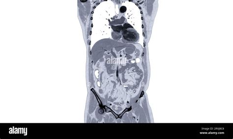 Ct Chest And Abdomen With Injection Contrast Media Coronal View For