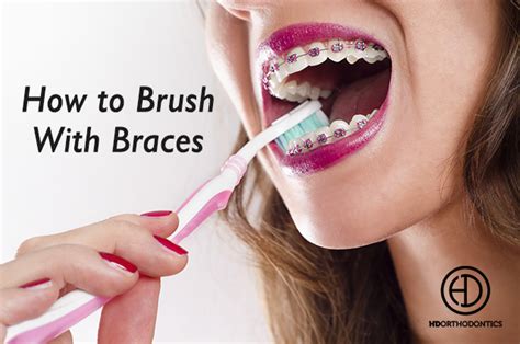 Tips For Brushing Your Teeth While Wearing Braces