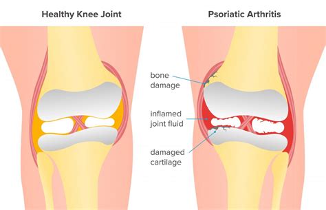 Artritis Psori Sica De Rodilla S Ntomas Y Tratamiento Salud Tudo