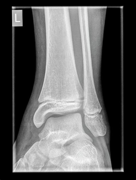 Ankle X Ray Photograph By Photostock Israel Pixels