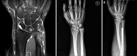 Ulnar Impaction Syndrome Wrist