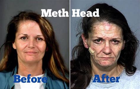 How To Spot Meth Heads Signs Symptoms Public Health
