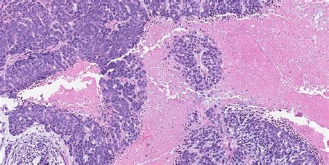 Pathology Outlines Myoepithelial Carcinoma