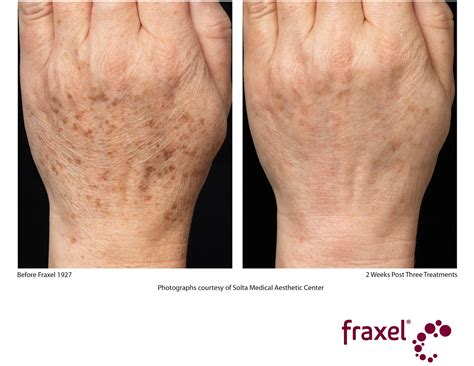 Fraxel® Dual Laser Treatments Laser Skin Resurfacing