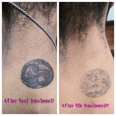 Top More Than 75 Tattoo After Laser Removal Best Incdgdbentre