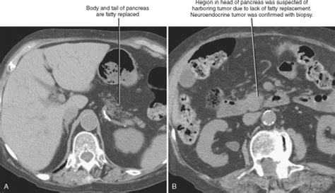 Pancreas Radiology Key