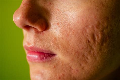 Say Goodbye To Spots Acne Scar Treatment And Removal In Sg