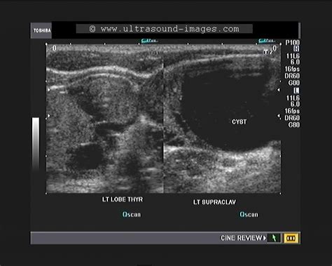 Wk 1 Thyroid Ultrasound Image Multinodular Goitre With Ectopic Thyroid