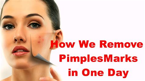 How To Remove Pimples Marks In One Day Get Rid Of Pimple Scars With