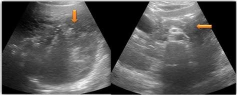 Above Ultrasonographic Images Shows Heterogeneous Hypoechoic Lesion In