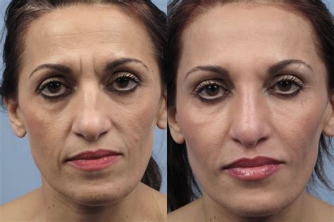 Fractional Laser Before And After Laser Facial Before And After Emerge