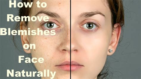 How To Remove Blemishes On Face Naturally With Results Of 3 Home