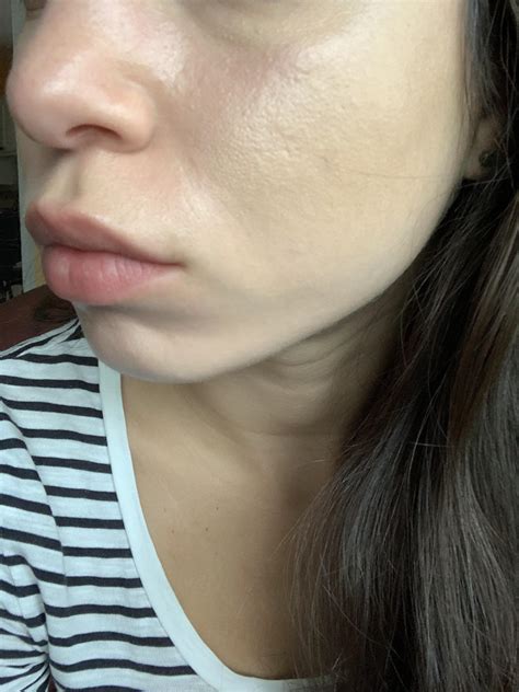 Skin Concerns Texture After Clearing Hormonal Acne Rskincareaddiction