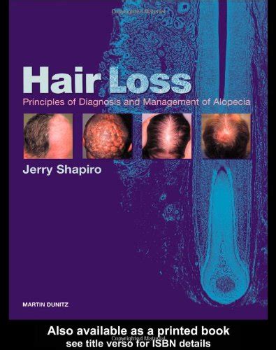 Hair Loss Principles Of Diagnosis And Management Of Alopecia