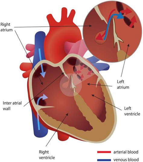 Patent Foramen Ovale Practical Neurology