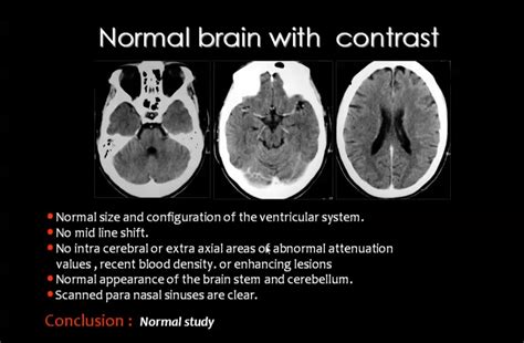 Case Study Normal Ct Brain With Contrast How To Report