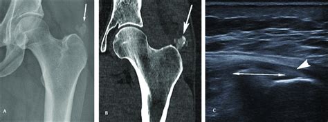 A Year Old Woman With Calcific Tendinitis Of The Left Gluteus Medius Download Scientific