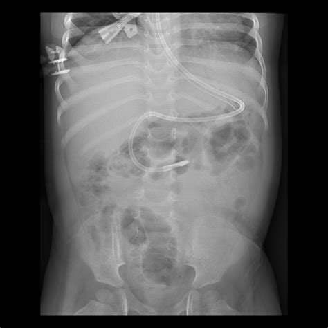 Toddler After Feeding Tube Placement Pediatric Radiology Case