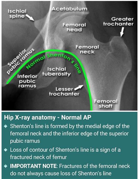 Hip X Rayloss Of Shentons Line Is A Sign Of Fx Neck Of Femur La