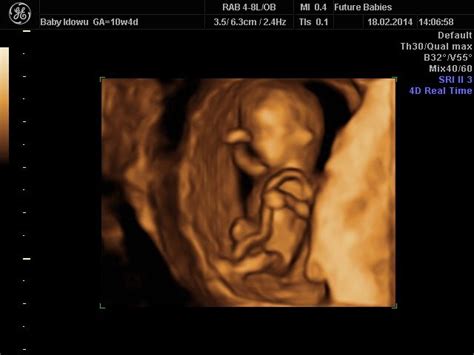 3d Image Of A Baby At 10 Weeks Gestation 3d Ultrasound Pictures