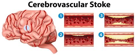 Diagram Showing Stages Of Cerebrovascular Stroke 455423 Vector Art At
