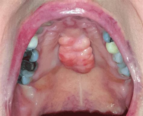 torus palatinus symptoms causes and treatment