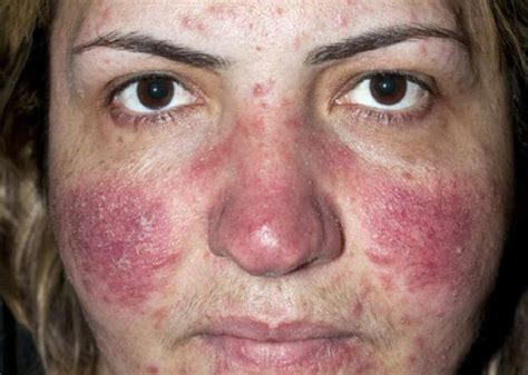 Rosacea Symptoms Causes Diagnosis And Treatment Natural Health News