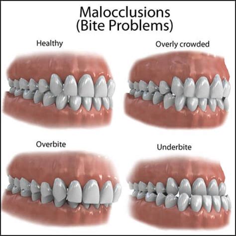 Malocclusion Definition Classes And Types