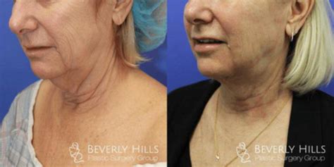 Doctor Layke Beverly Hills California Spouse Treated With Facetite Picture Facelift Info