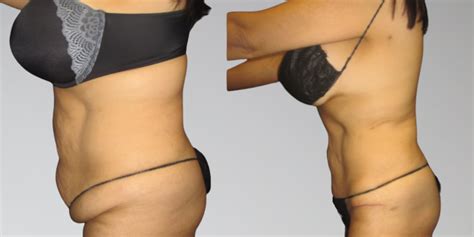 Stomach Liposuction Before And After Photos By Sono Bello