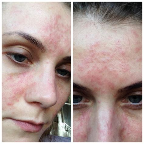 My skin gets badly exposed to the dirt and pollution every day. How I got rid of congestion and constant breakouts.Social ...