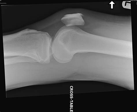 Total Knee Dislocation A Falsely Reassuring Radiograph Emergency