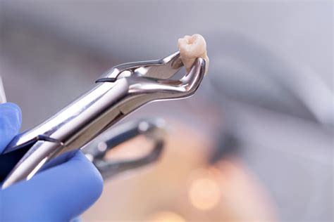 Wisdom Teeth Removal And Oral Surgery Prosper Tx Minty Fresh Dental